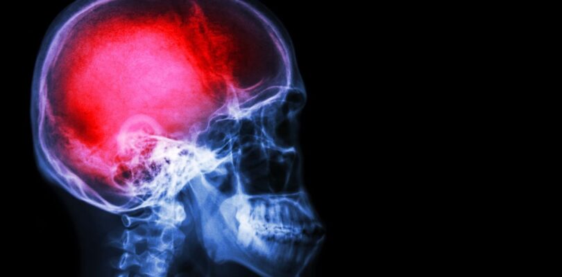 Some traumatic brain injuries linked to increased risk of brain cancer